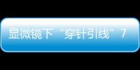 显微镜下“穿针引线”7小时�！金湾这家医院成功帮患者保住断肢